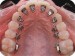 rovnátka na zadní straně zubů